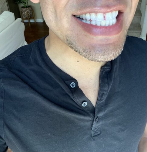 Klikněte pro zobrazení na celou obrazovku Sonický čistič zubů 5v1 Dental PRO photo review