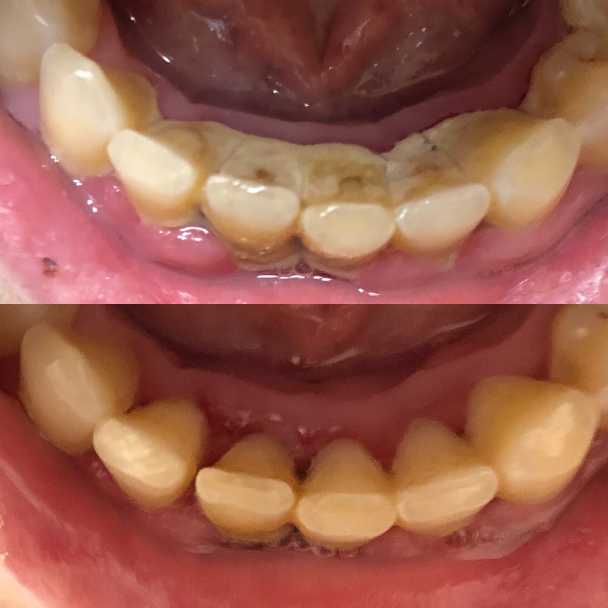 Ultrazvukový čistič zubů TrueSonic photo review