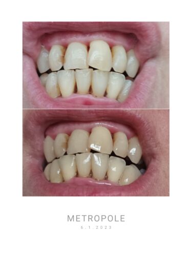 Ultrasonický čistič zubů TrueSonic™ photo review