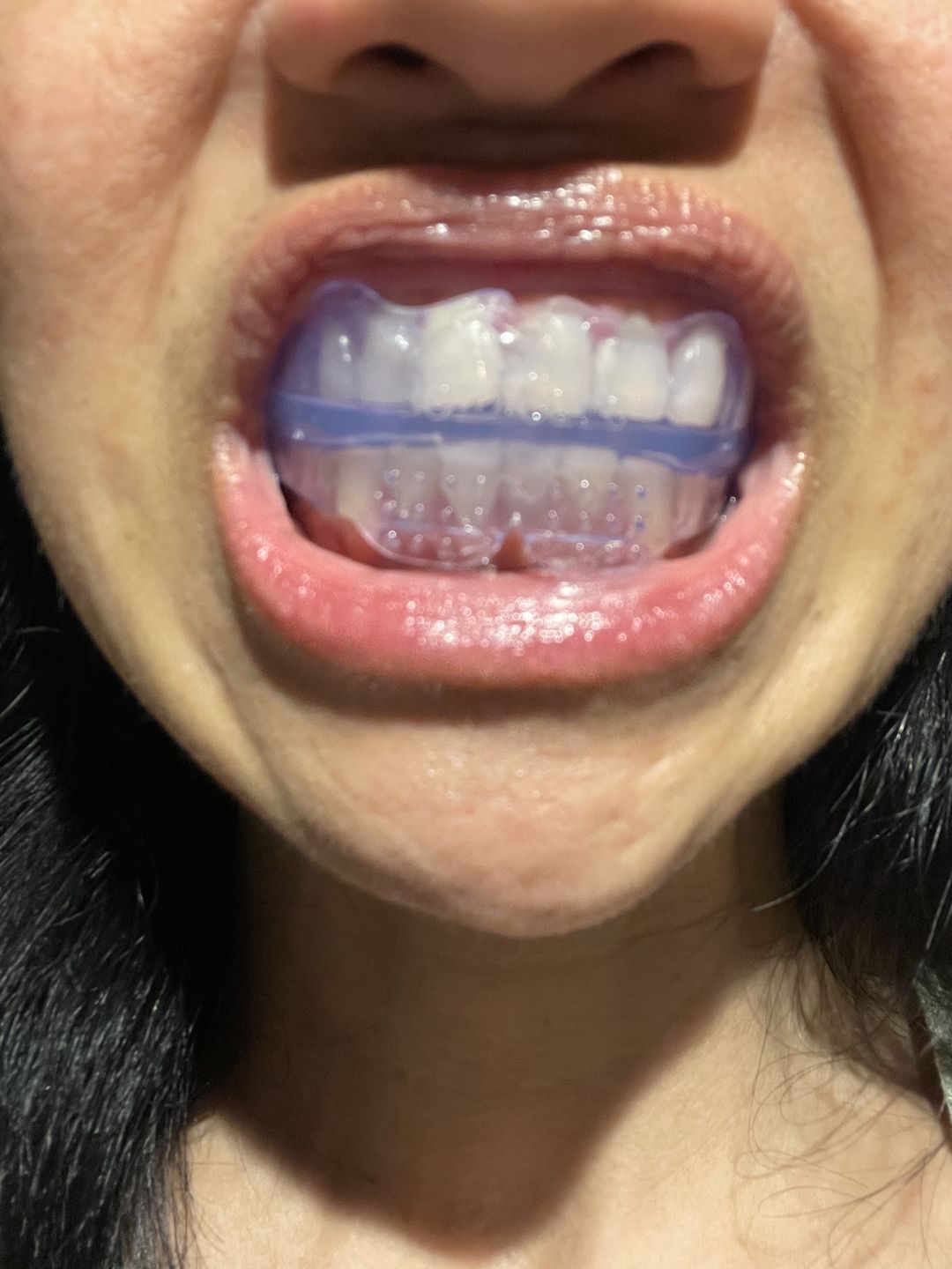 Dormi&îndreaptă gutieră dentară photo review