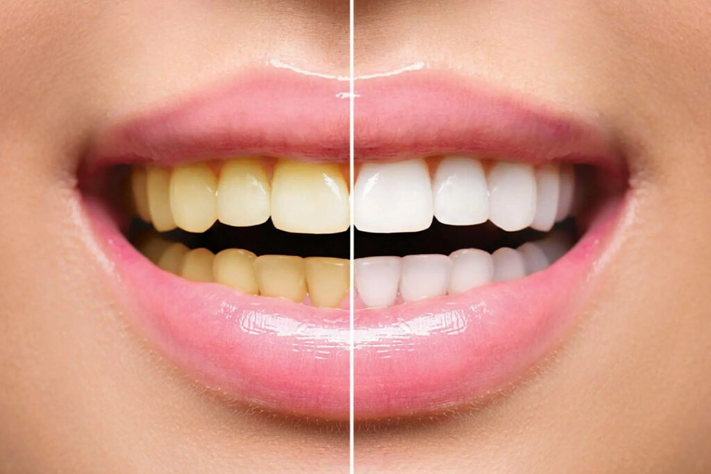 Jak odstranit pigmentové skvrny na zubech?